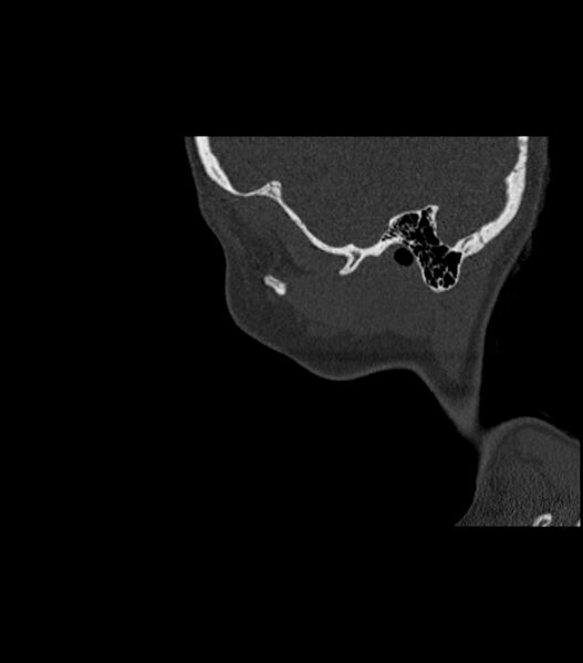 File:Nasoorbitoethmoid fracture (Radiopaedia 90044-107205 Sagittal bone window 23).jpg