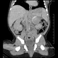Neonatal neuroblastoma (Radiopaedia 56651-63438 Coronal non-contrast 30).jpg