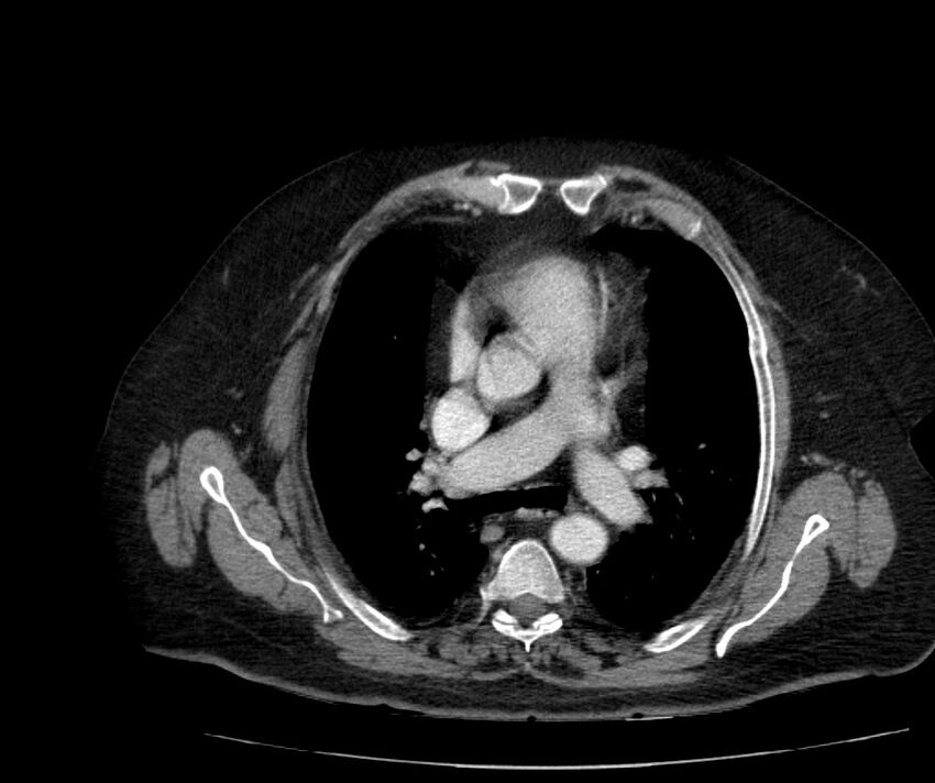 Nephroptosis with inguinal hernia containing perirenal fat (Radiopaedia 56632-63391 C 1).jpg