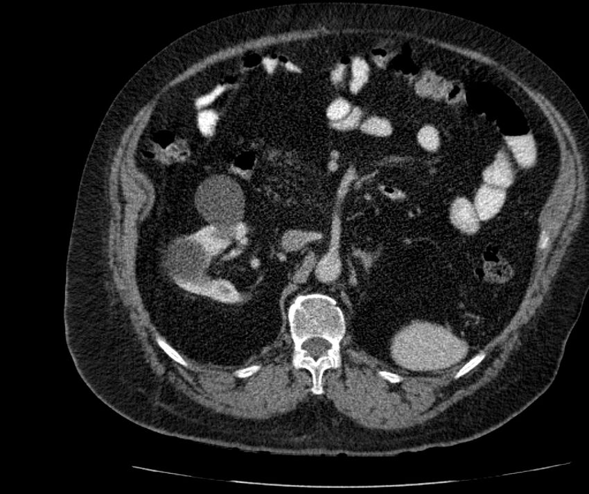 Nephroptosis with inguinal hernia containing perirenal fat (Radiopaedia 56632-63391 C 137).jpg