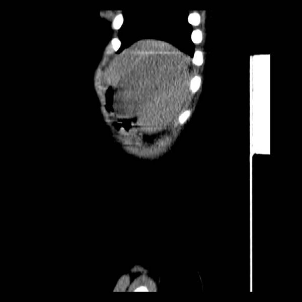 File:Neuroblastoma with skull metastases (Radiopaedia 30326-30960 B 44).jpg
