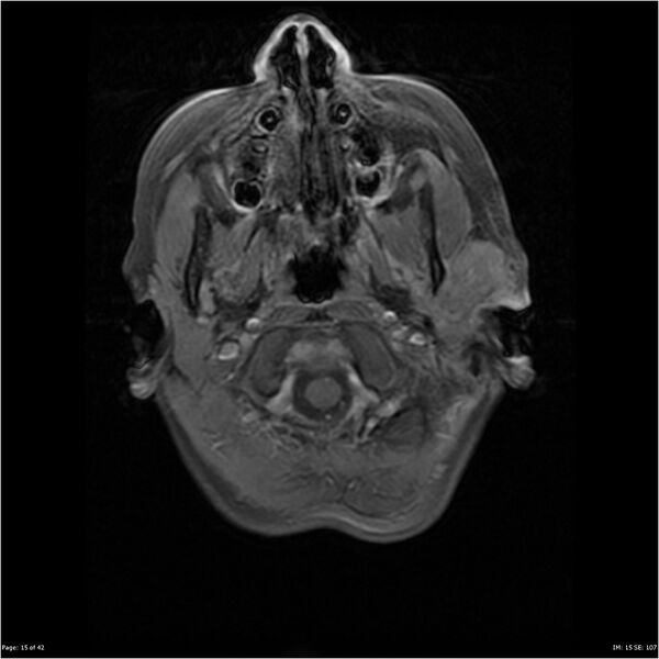 File:Neurofibromatosis type 1 (Radiopaedia 22541-22564 Axial T1 C+ fat sat 15).jpg