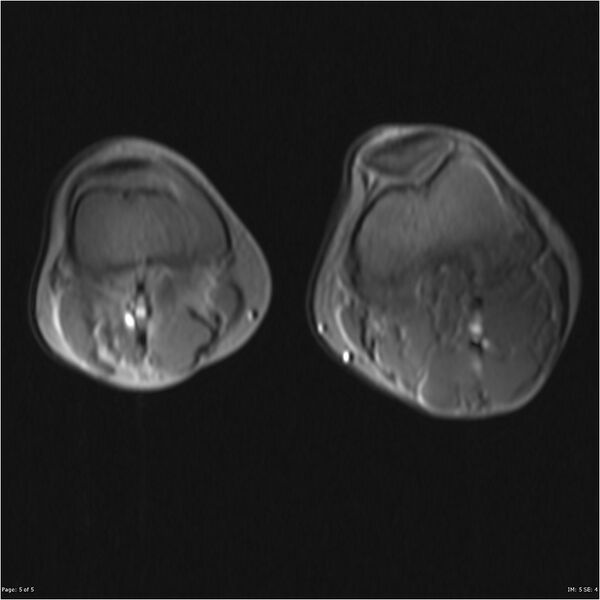 File:Neurofibromatosis type 1 (Radiopaedia 22541-22566 Axial Localiser 3).jpg