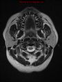 Neuroglial cyst (Radiopaedia 10713-11184 Axial T2 23).jpg