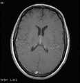 Neurosarcoidosis (Radiopaedia 10930-17204 Axial T1 C+ 11).jpg