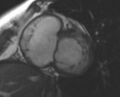 Non-compaction of the left ventricle (Radiopaedia 69436-79314 Short axis cine 161).jpg
