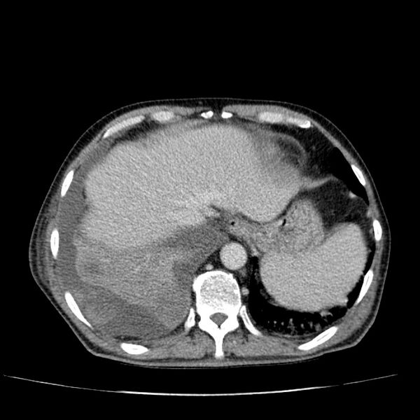 File:Non small-cell lung cancer (Radiopaedia 24467-24769 C+ delayed 52).jpg