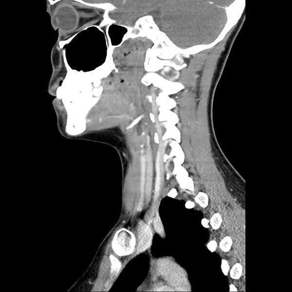 File:Normal CT of the neck (Radiopaedia 14575-14500 Sagittal C+ 21).jpg