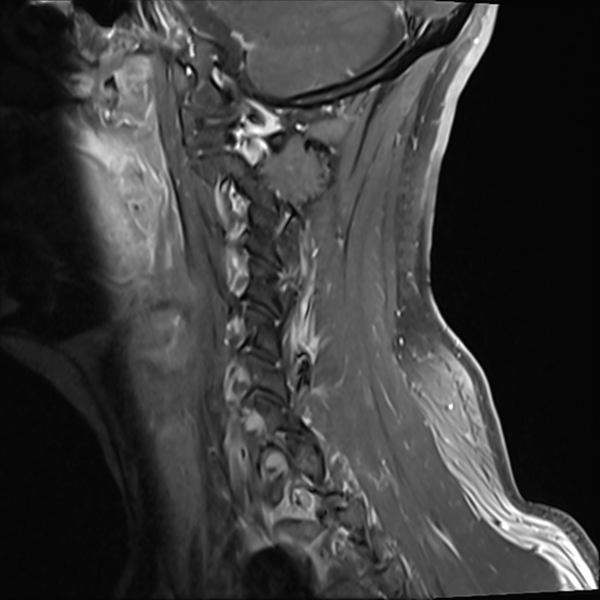 File:Normal MRI cervical spine (infection protocol) (Radiopaedia 53916-60039 I 13).png