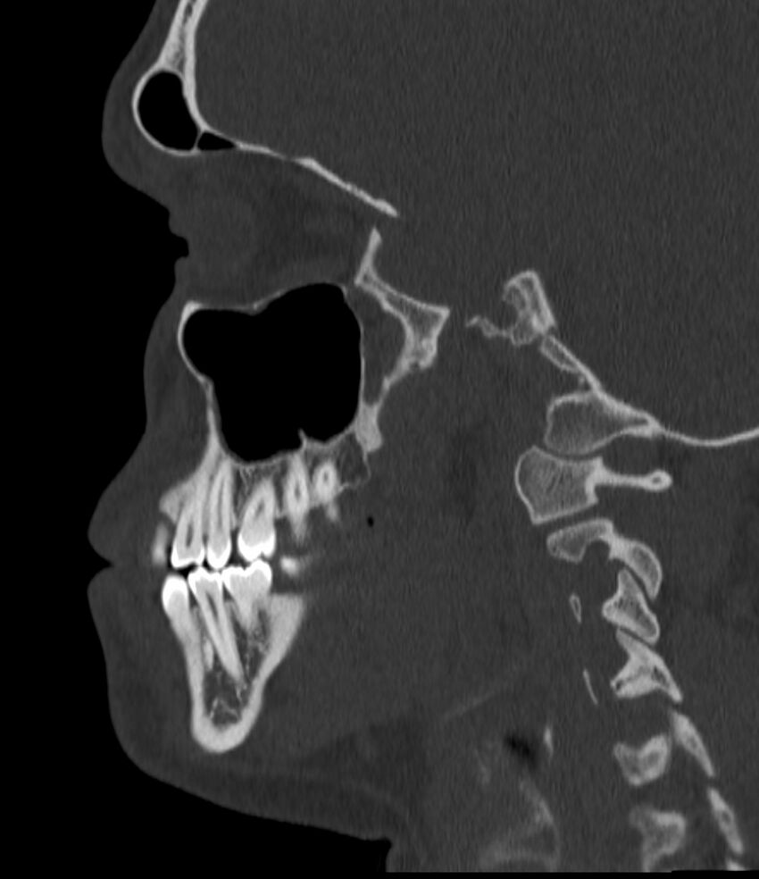 Normal facial bone CT (Radiopaedia 88742-105476 Sagittal bone window 107).jpg