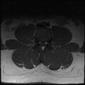 Normal lumbar spine MRI (Radiopaedia 47857-52609 Axial T1 10).jpg
