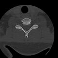 Occipital condyle fracture (Radiopaedia 31755-32691 Axial bone window 60).jpg