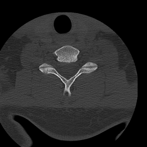 File:Occipital condyle fracture (Radiopaedia 31755-32691 Axial bone window 60).jpg