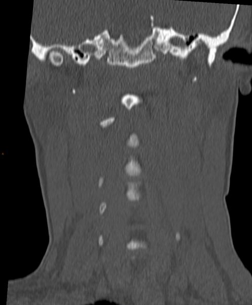 File:Occipital condyle fracture (Radiopaedia 61165-69056 Coronal bone window 12).jpg