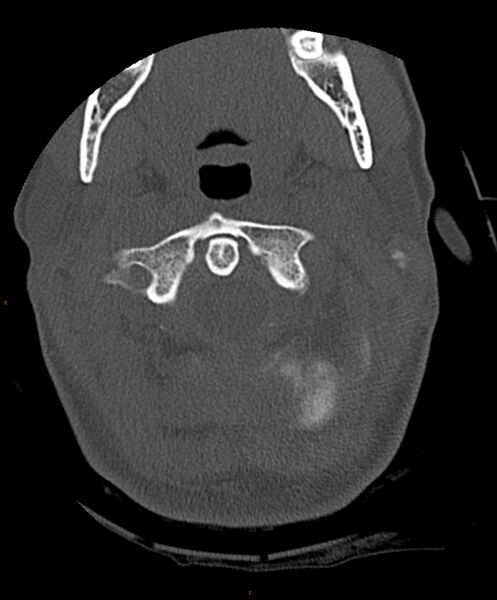File:Occipital condyle fracture (Radiopaedia 61165-69056 D 9).jpg