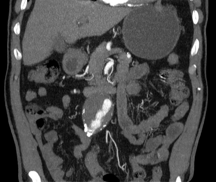 File:Abdominal aortic aneurysm (Radiopaedia 22421-22458 C 13).jpg
