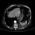 Abdominal aortic aneurysm (Radiopaedia 25855-26001 Axial C+ arterial phase 24).jpg