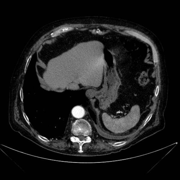 File:Abdominal aortic aneurysm (Radiopaedia 25855-26001 Axial C+ arterial phase 24).jpg