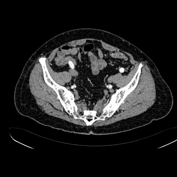 File:Abdominal aortic aneurysm (Radiopaedia 75131-86203 Axial C+ arterial phase 38).jpg