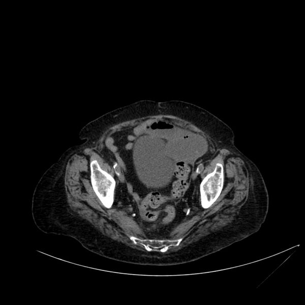 File:Abdominal aortic aneurysm - impending rupture (Radiopaedia 19233-19246 Axial non-contrast 106).jpg