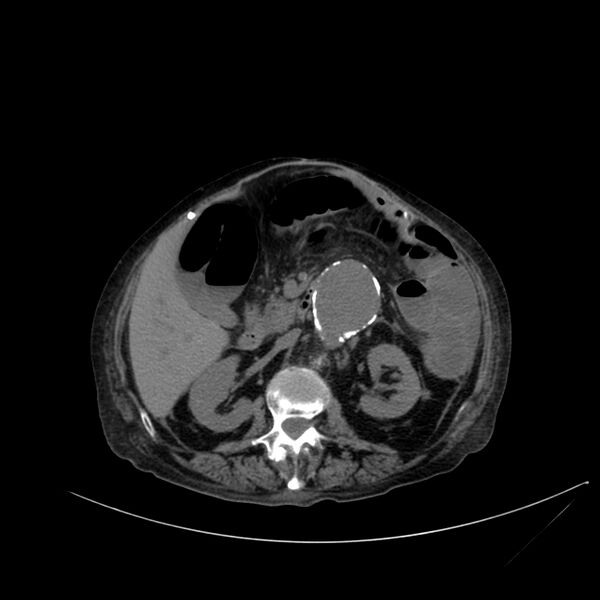 File:Abdominal aortic aneurysm - impending rupture (Radiopaedia 19233-19246 Axial non-contrast 54).jpg