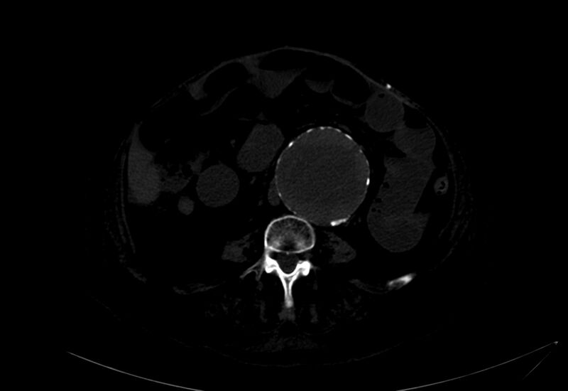 File:Abdominal aortic aneurysm - impending rupture (Radiopaedia 19233-19246 B 24).jpg