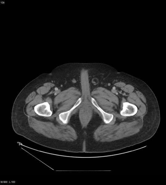 File:Abdominal aortic aneurysm with intramural hematoma then rupture (Radiopaedia 50278-55631 Axial C+ arterial phase 129).jpg