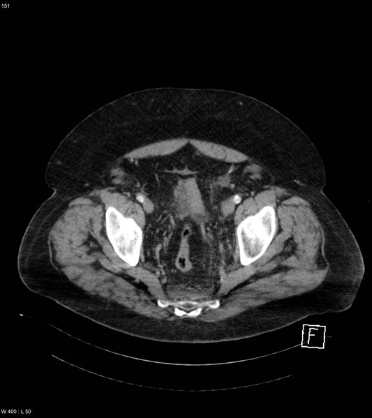File:Abdominal aortic aneurysm with intramural hematoma then rupture (Radiopaedia 50278-55632 Axial C+ arterial phase 150).jpg