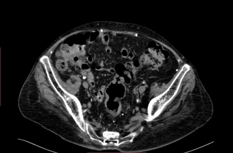 File:Abdominal aortic interposition tube graft and aneurysm thrombosis (Radiopaedia 71438-81857 Axial C+ arterial phase 182).jpg