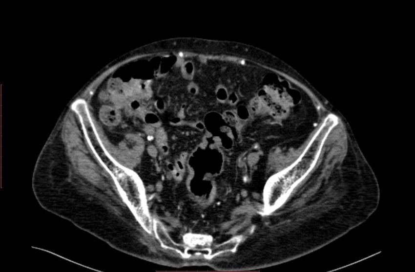 Abdominal aortic interposition tube graft and aneurysm thrombosis (Radiopaedia 71438-81857 Axial C+ arterial phase 182).jpg
