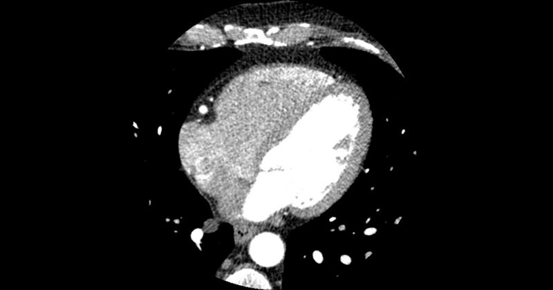 File:Aberrant left main coronary artery (ALMCA) arising from the right sinus with interarterial course (Radiopaedia 63251-71814 Axial C+ arterial phase 120).JPG