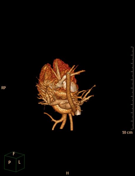 File:Aberrant left pulmonary artery (pulmonary sling) (Radiopaedia 42323-45435 3D reconstruction C+ CTPA 16).jpg