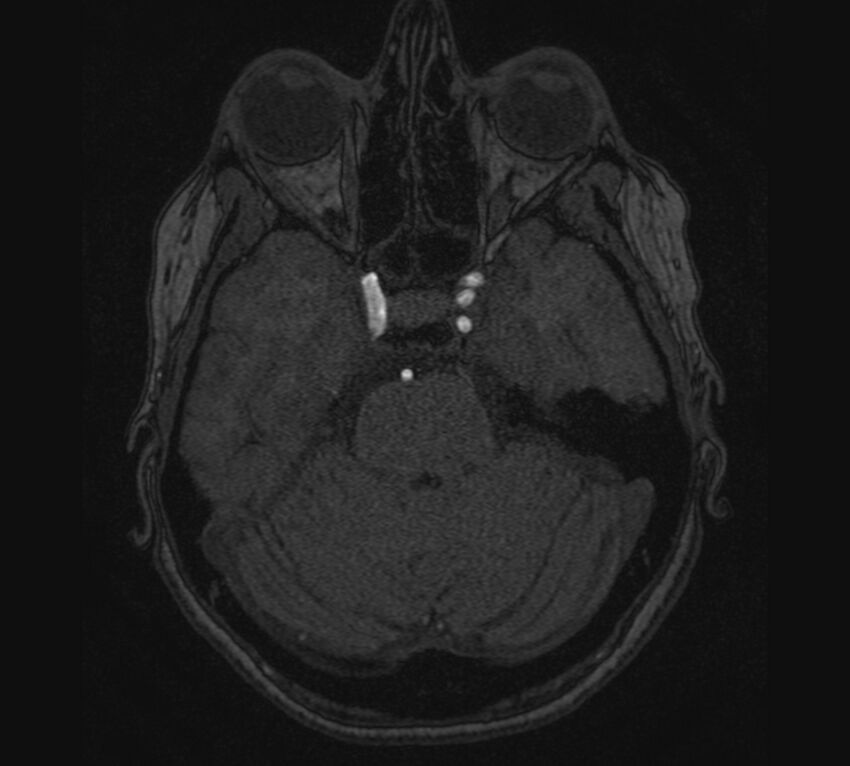 Accessory middle cerebral artery and ICA aneurysm (Radiopaedia 22656-22674 MRA 25).jpg