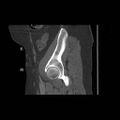 Acetabular fracture (Radiopaedia 13193-13212 Sagittal bone window 23).jpg