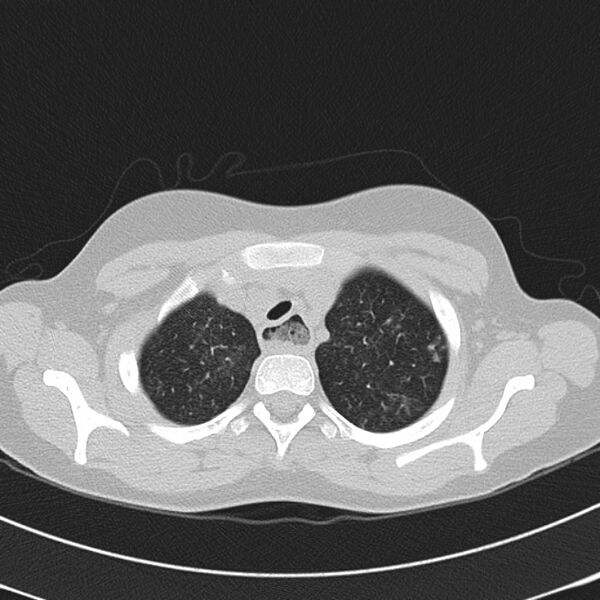 File:Achalasia (Radiopaedia 14946-14878 Axial lung window 9).jpg
