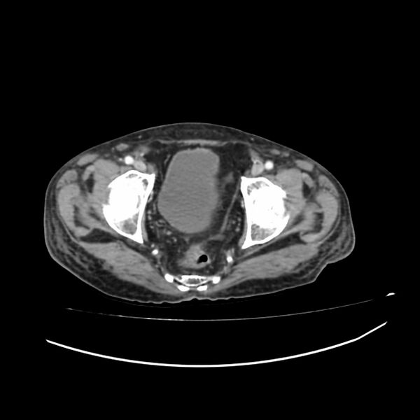 File:Acute-on-chronic Crohn disease with enteroenteric fistula (Radiopaedia 66686-75987 B 77).jpg