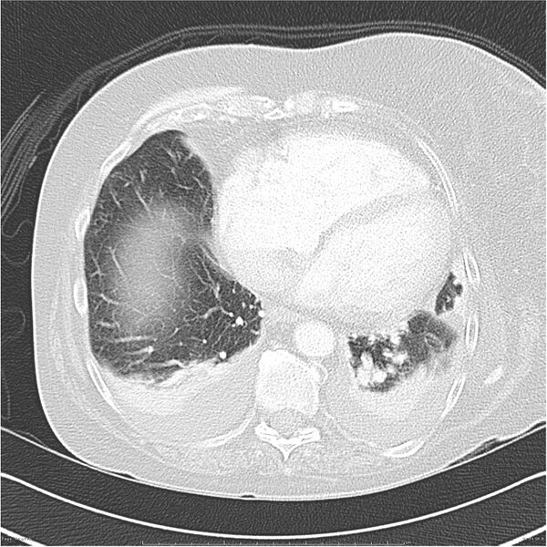 File:Acute-on-chronic pulmonary emboli (Radiopaedia 27925-28169 lung window 34).jpg