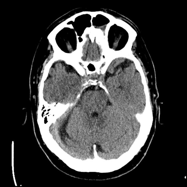File:Acute A3 occlusion with ACA ischemic penumbra (CT perfusion) (Radiopaedia 72036-82525 Axial non-contrast 14).jpg