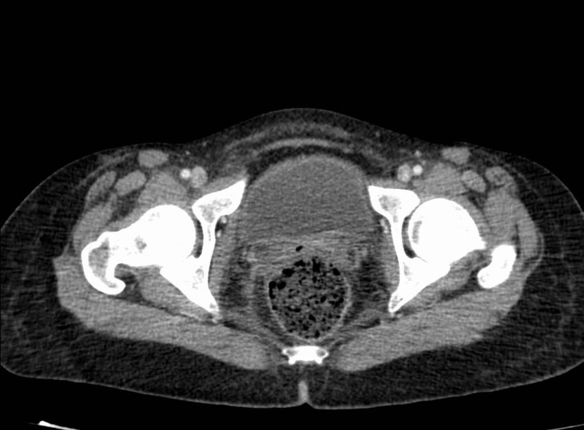 Acute Budd-Chiari syndrome (Radiopaedia 60858-68638 Axial C+ portal venous phase 289).jpg