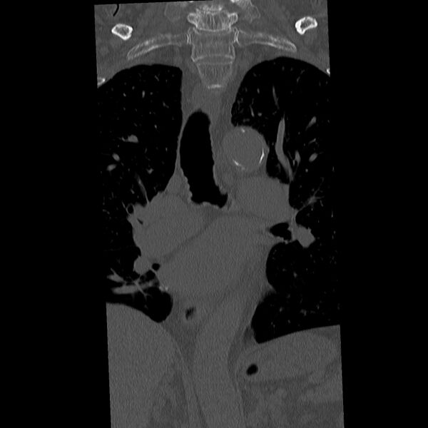 File:Acute and chronic vertebral compression fractures (Radiopaedia 31608-32494 Coronal bone window 4).jpg