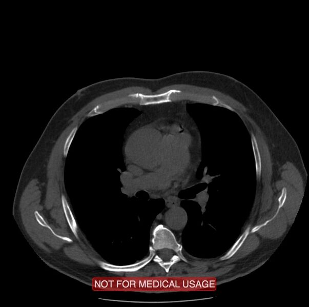 File:Acute aortic dissection - Stanford type A (Radiopaedia 40661-43285 Axial non-contrast 24).jpg