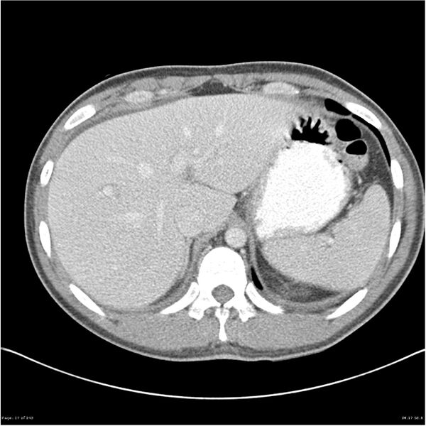 File:Acute appendicitis (Radiopaedia 25364-25615 B 7).jpg