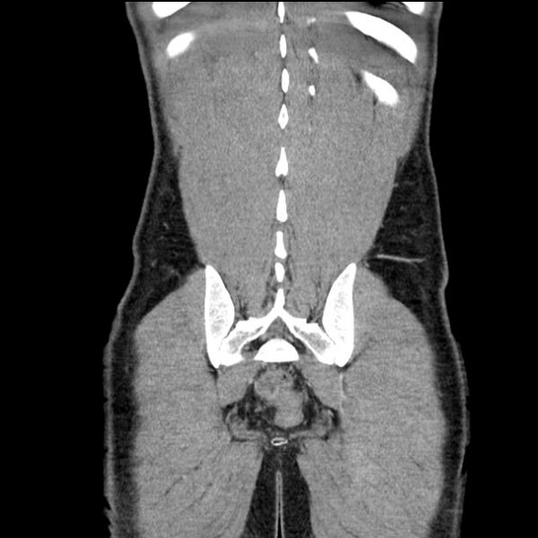 File:Acute appendicitis (Radiopaedia 27049-27227 Coronal C+ portal venous phase 51).jpg