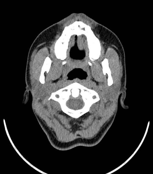 File:Acute bacterial tonsillitis (Radiopaedia 22882-22908 Axial non-contrast 11).png
