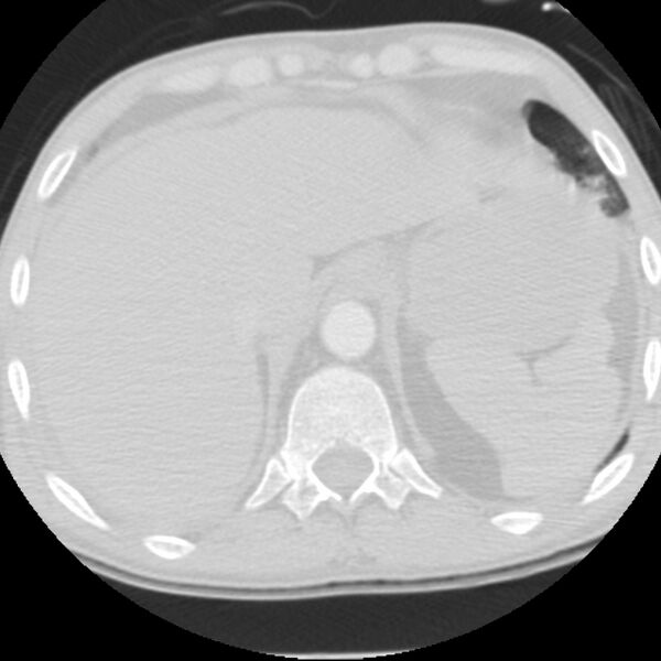 File:Acute diffuse alveolar hemorrhage (Radiopaedia 41323-44158 Axial lung window 59).jpg