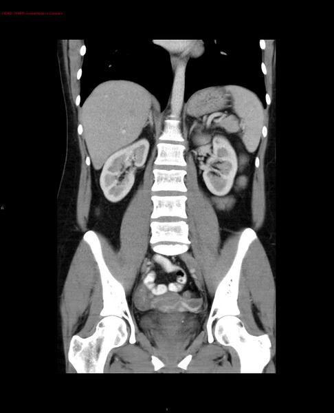 File:Acute gastritis (Radiopaedia 21043-20975 Coronal C+ portal venous phase 9).jpg