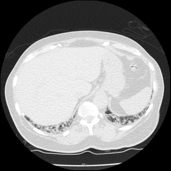 File:Acute interstitial pneumonitis (Radiopaedia 45404-49444 Axial lung window 89).jpg