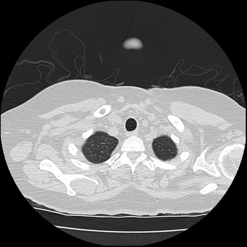 Acute interstitial pneumonitis (Radiopaedia 45404-49452 Axial lung window 7).jpg