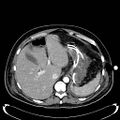 Acute pancreatic necrosis (Radiopaedia 13560-18500 Axial C+ portal venous phase 35).jpg
