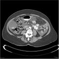 Acute pancreatitis (Radiopaedia 19136-19117 Axial C+ portal venous phase 25).jpg